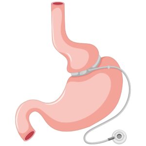 Illustration of how a gastric band, also known as Lap-band, is placed on the stomach.