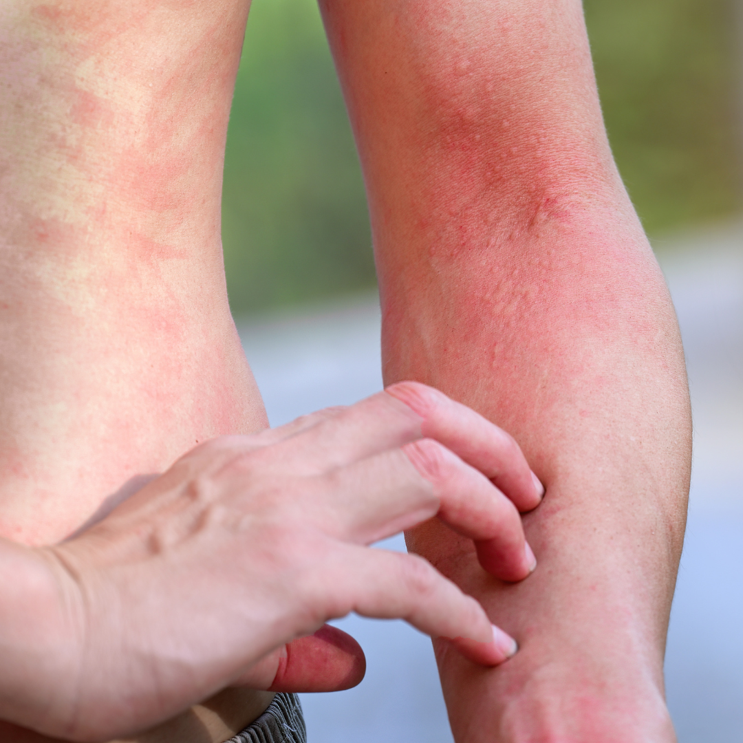 mysterious rash caused by environmental triggers