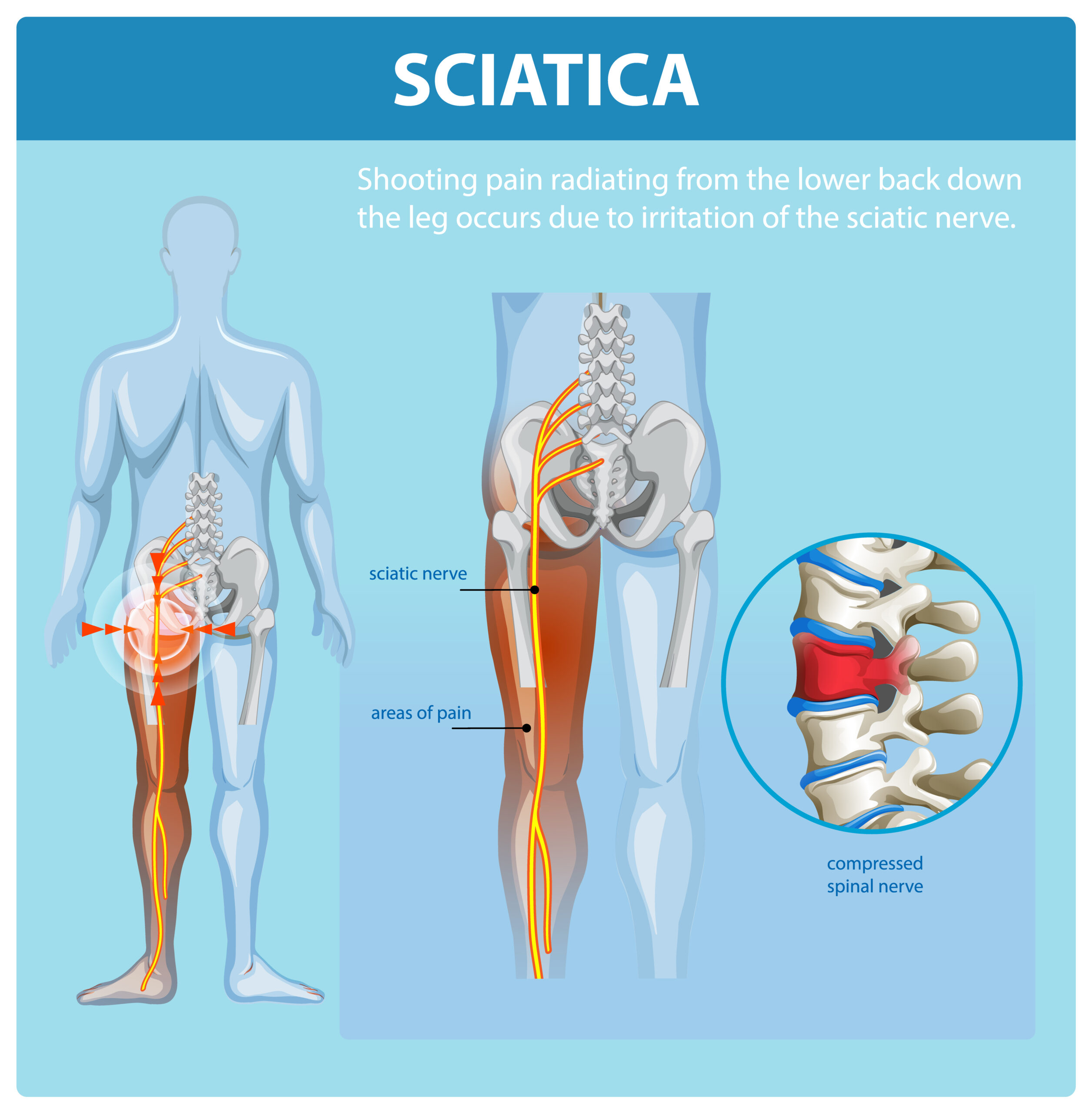 Understanding Sciatica and Its Symptoms