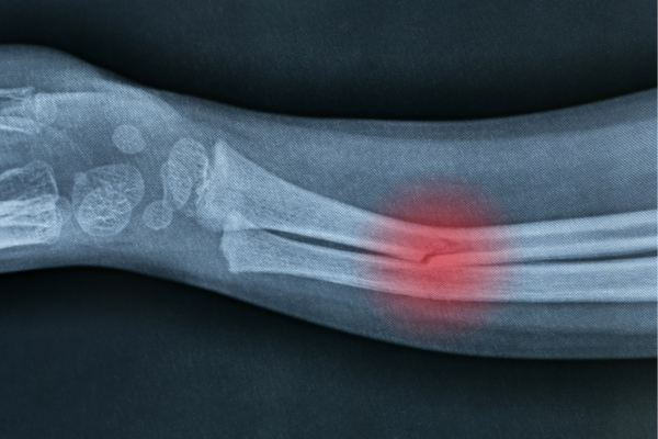 X-ray of a broken arm due to osteoporosis
